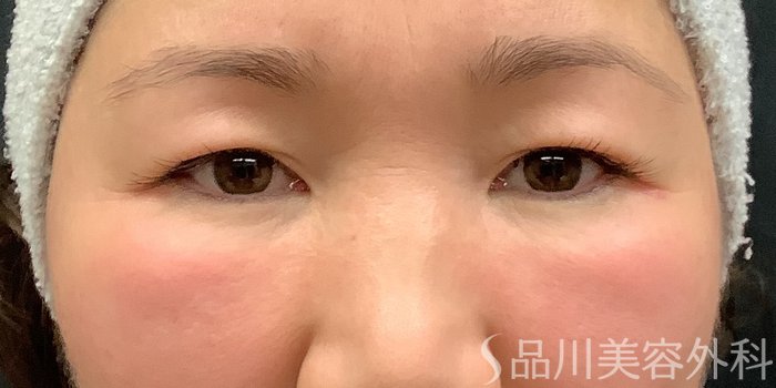 症例NO.65198のBEFORE写真