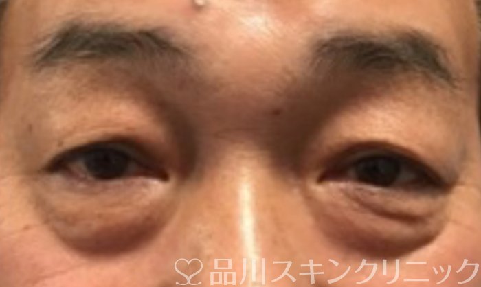 症例NO.64102のBEFORE写真