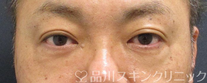 症例NO.65090のBEFORE写真