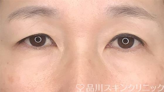 症例NO.60034のBEFORE写真