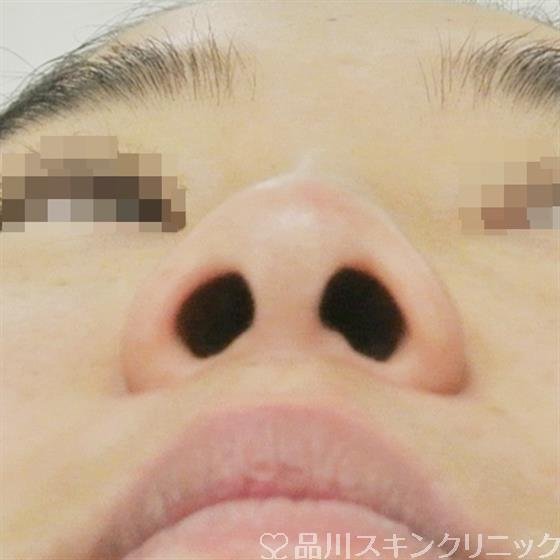 症例NO.36817のBEFORE写真