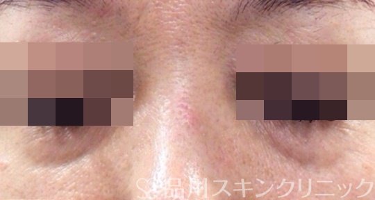 症例NO.67695のBEFORE写真