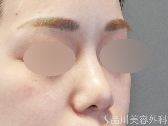 症例NO.67385のBEFORE写真