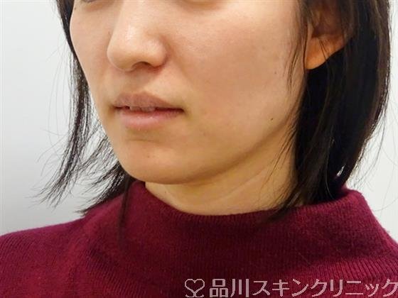 症例NO.48938のBEFORE写真