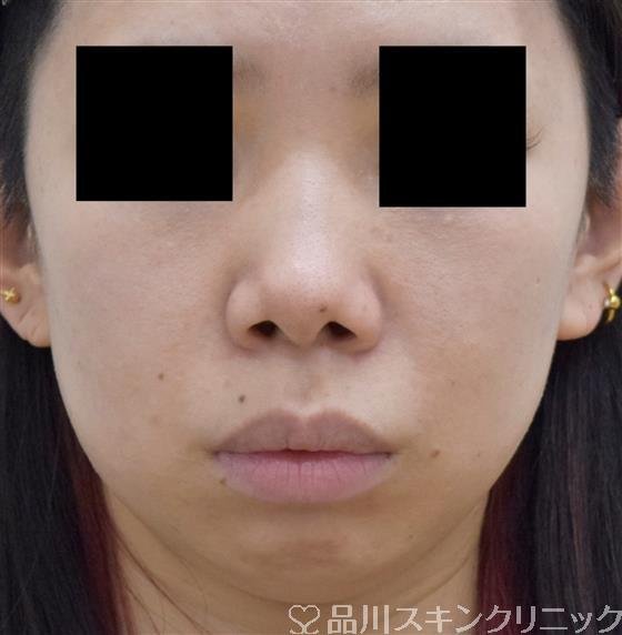 症例NO.60345のBEFORE写真