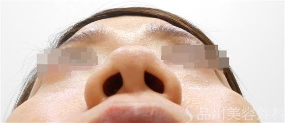 症例NO.31345のBEFORE写真