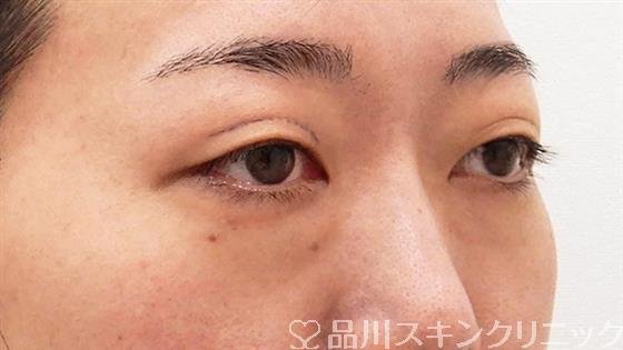 症例NO.61696のBEFORE写真