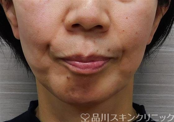 症例NO.48339のBEFORE写真