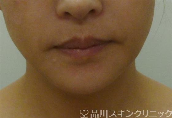 症例NO.40288のBEFORE写真