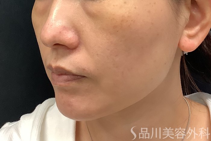 症例NO.63236のBEFORE写真