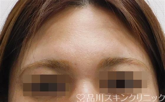 症例NO.60394のBEFORE写真