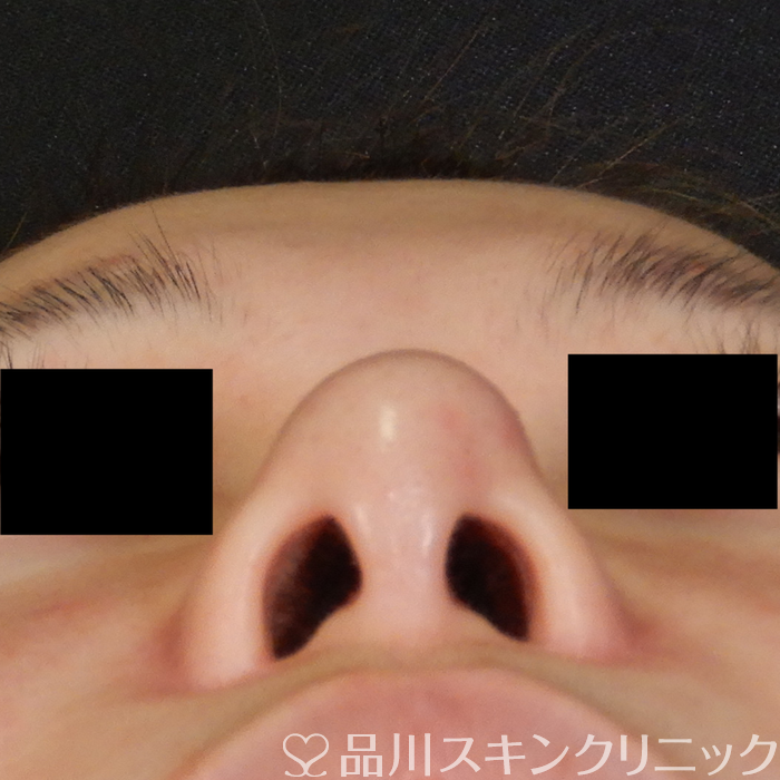 症例NO.63105のBEFORE写真