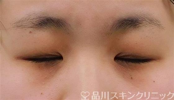 症例NO.41200のBEFORE写真