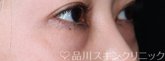 症例NO.64034のBEFORE写真