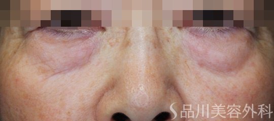 症例NO.68721のBEFORE写真