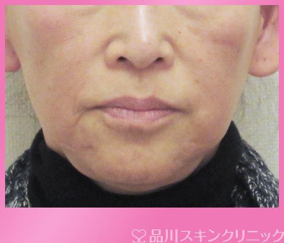 症例NO.27842のBEFORE写真