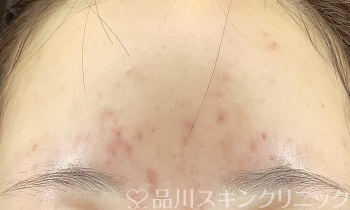 症例NO.67306のBEFORE写真