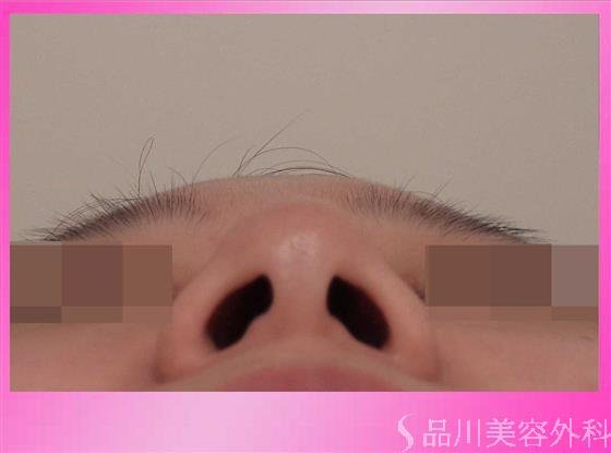 症例NO.32510のBEFORE写真