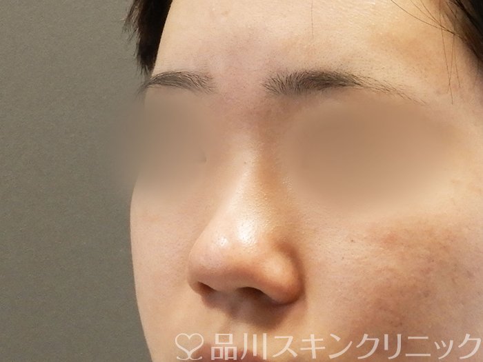 症例NO.65171のBEFORE写真