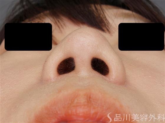 症例NO.60678のAFTER写真