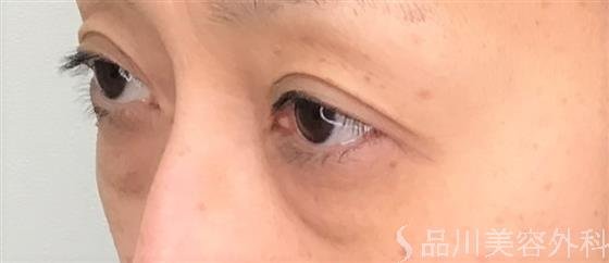 症例NO.54840のBEFORE写真