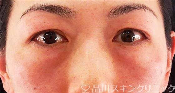 症例NO.59299のBEFORE写真