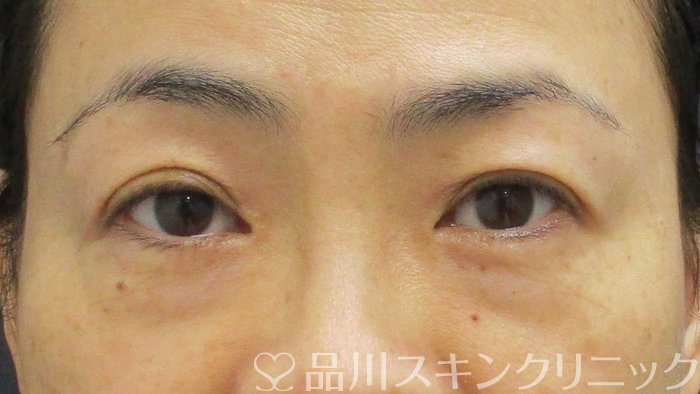 症例NO.67338のBEFORE写真