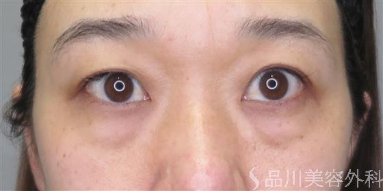 症例NO.46898のBEFORE写真