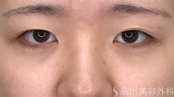 症例NO.56080のBEFORE写真