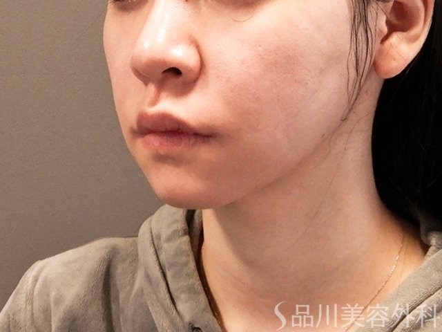 症例NO.68128のBEFORE写真