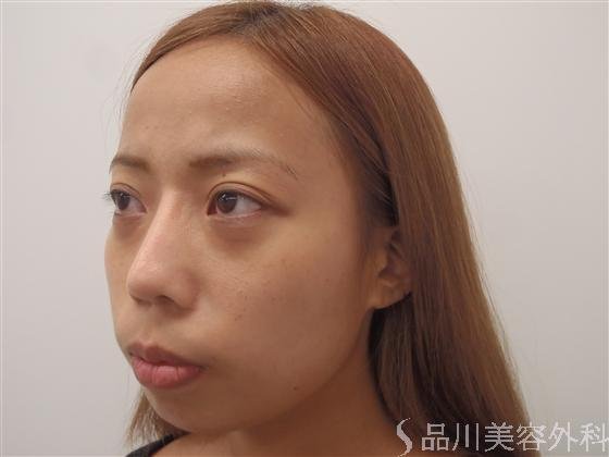 症例NO.16164のBEFORE写真