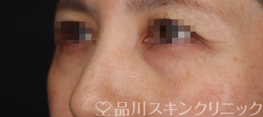 症例NO.64149のBEFORE写真