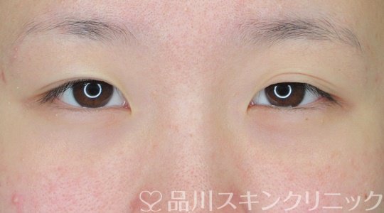 症例NO.67303のBEFORE写真