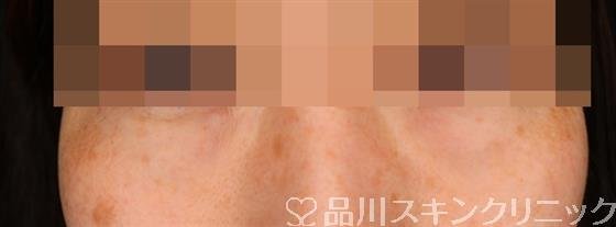 症例NO.54199のBEFORE写真