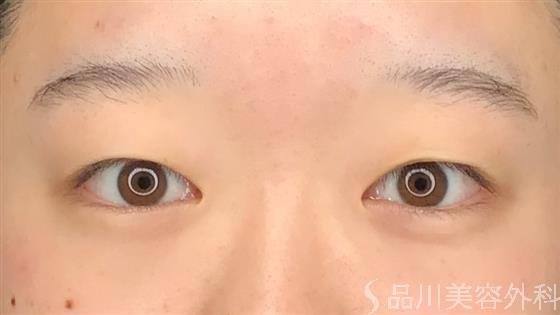 症例NO.60552のBEFORE写真