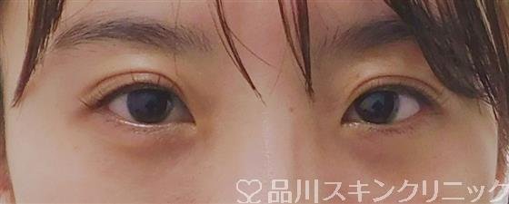 症例NO.59432のAFTER写真