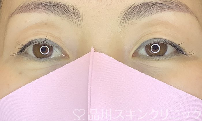 症例NO.65722のBEFORE写真