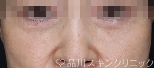 症例NO.64994のAFTER写真