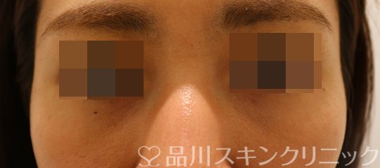 症例NO.68537のAFTER写真