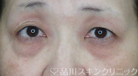 症例NO.66210のBEFORE写真