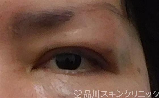 症例NO.41081のAFTER写真