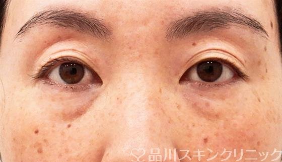 症例NO.61489のBEFORE写真