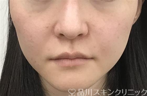 症例NO.46829のBEFORE写真