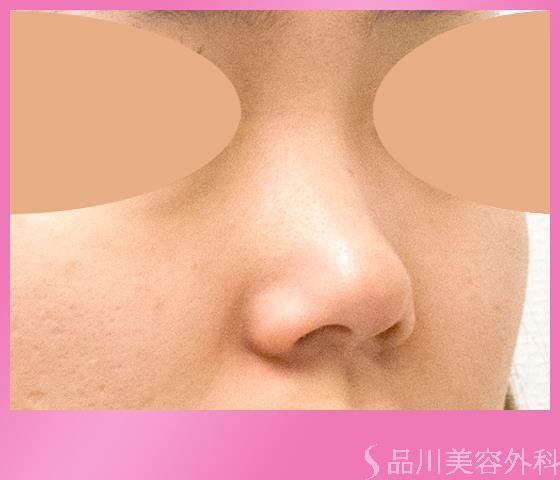 症例NO.22239のBEFORE写真