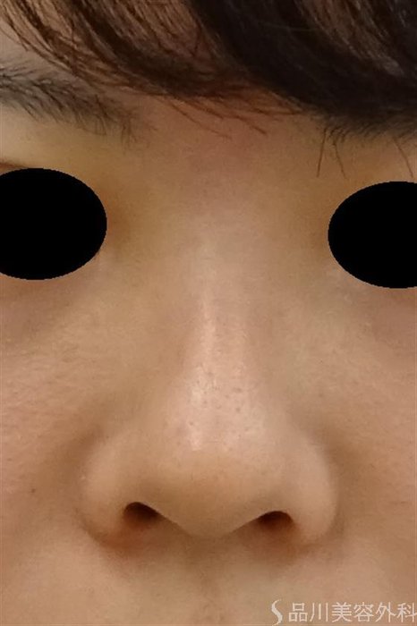 症例NO.42019のBEFORE写真