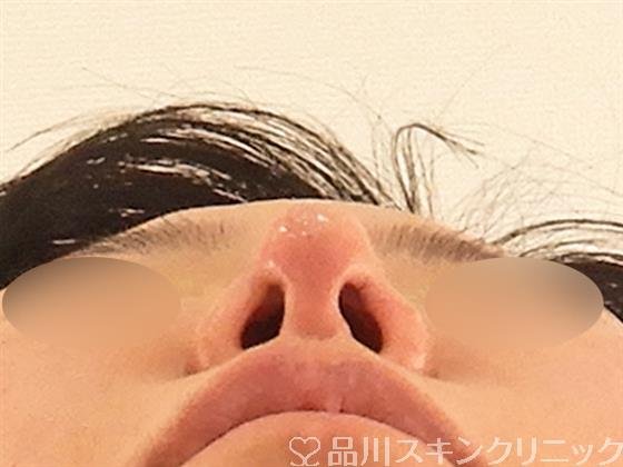 症例NO.58374のAFTER写真