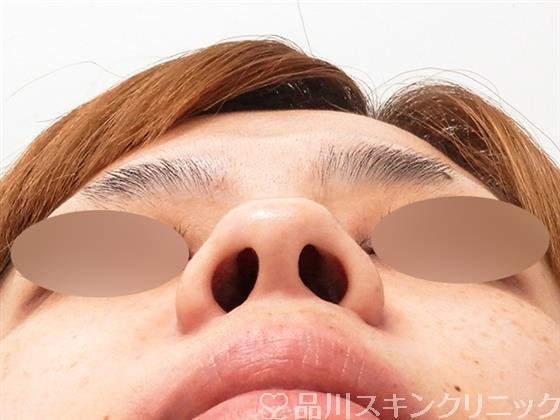 症例NO.55802のBEFORE写真