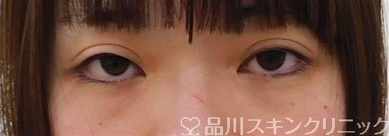 症例NO.40889のBEFORE写真