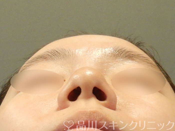 症例NO.66825のBEFORE写真