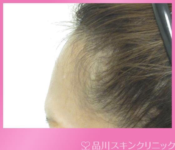 症例NO.27249のBEFORE写真